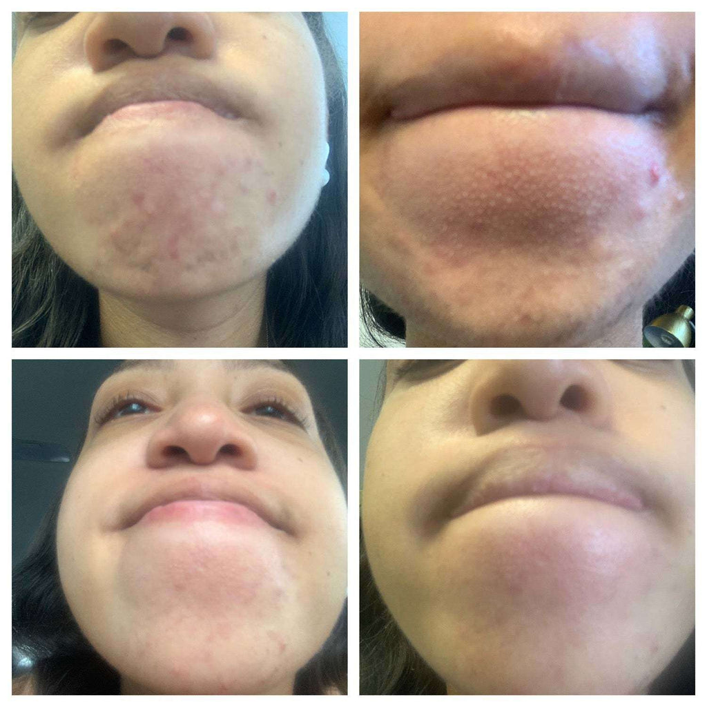 The Spoiled Mama Rehab Serum: Say Goodbye to Blemishes in - Serum > best acne treatment for pregnancy > acne toner > pregnancy acne treatment > pregnancy safe acne treatment > best acne treatment for pregnancy > pregnancy safe face care > pregnancy hormonal acne > acne cream for pregnancy photo