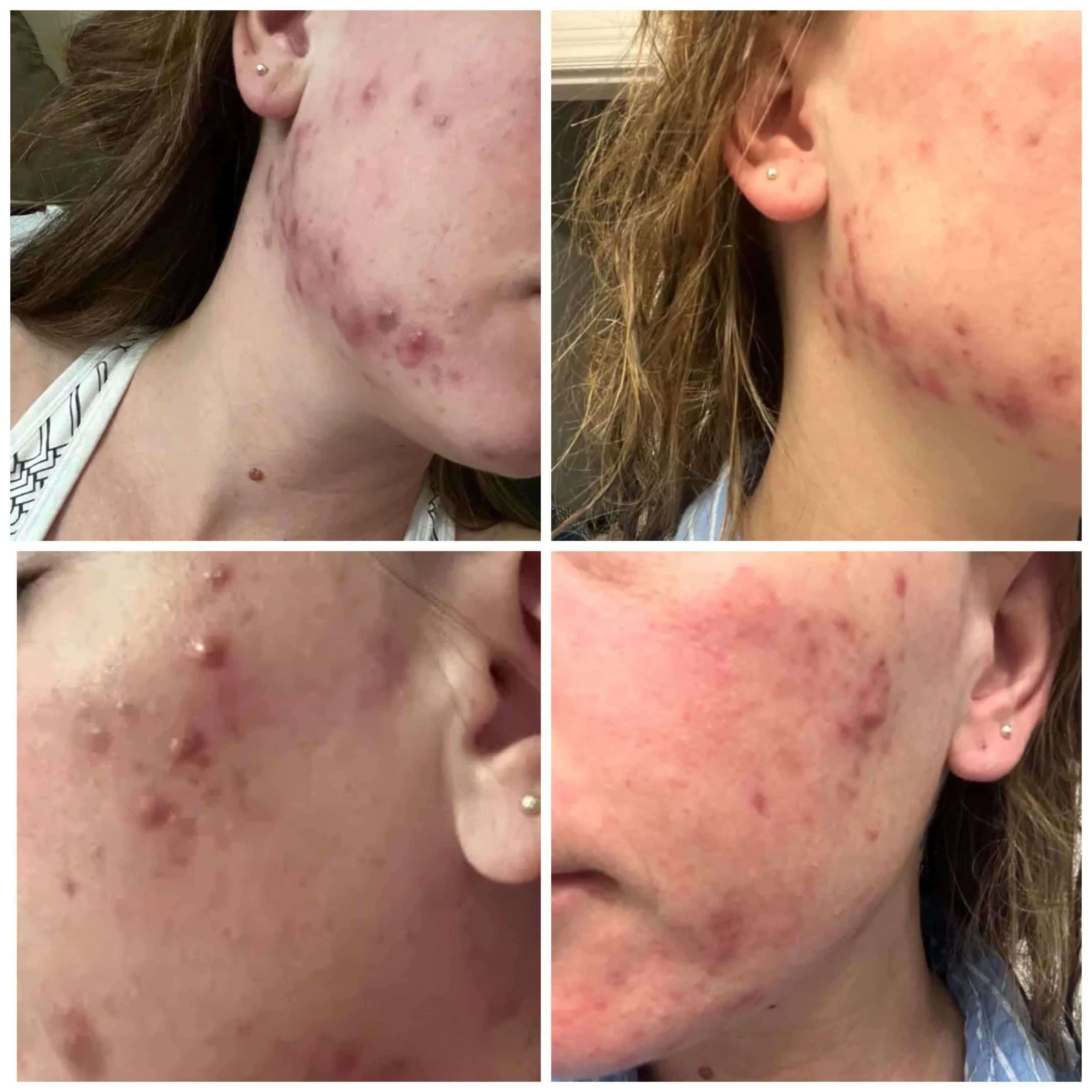 BalanC Pregnancy Acne Toner
