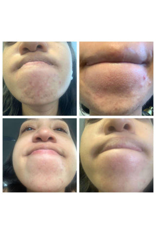 The Spoiled Mama Pregnancy Acne Treatment Kit