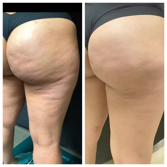 The Spoiled Mama Cheek Chic Cellulite Gel in - Postpartum > cellulite cream gel photo