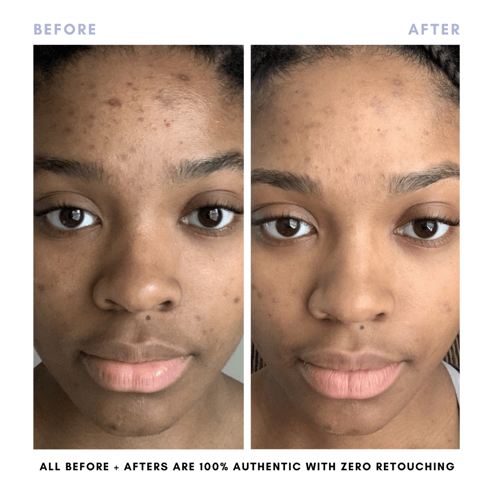 Sarah's Triple Threat | For Acne-Prone Maturing Skin -