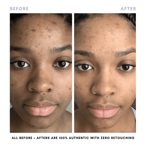 Sarah's Triple Threat | For Acne-Prone Maturing Skin -