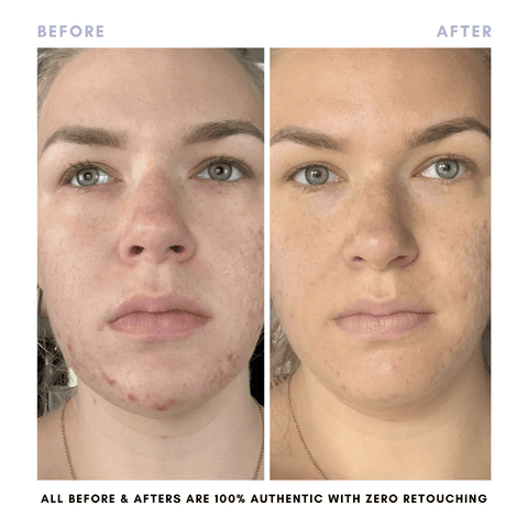 Sarah's Triple Threat | For Acne-Prone Maturing Skin -