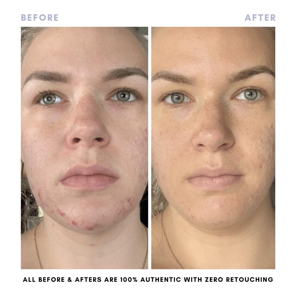 The Clear + Calm Skin Set | Acne + Skin Barrier Support Essentials -