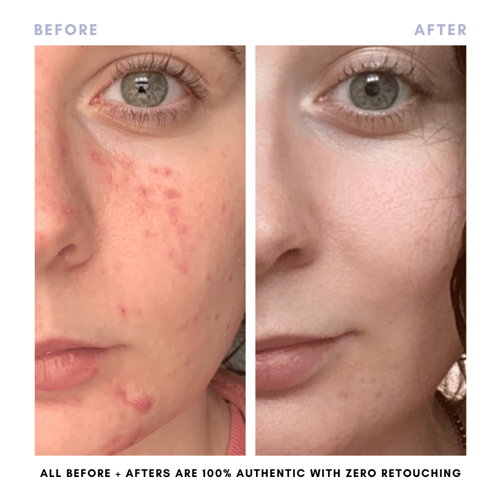 Sarah's Triple Threat | For Acne-Prone Maturing Skin -
