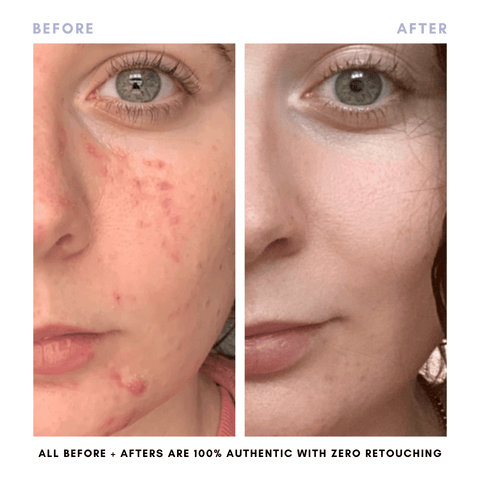 Sarah's Triple Threat | For Acne-Prone Maturing Skin -