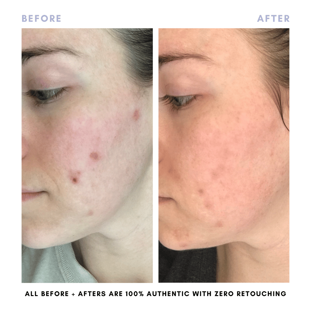 Sarah's Triple Threat | For Acne-Prone Maturing Skin -