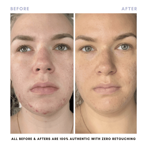 The Balanced Skin Set (Travel-Size) in - Skincare photo