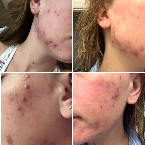The Spoiled Mama Pregnancy-safe Blemish Treatment Kit in - Maternity Gift Basket, best acne treatment for pregnancy > acne toner > pregnancy acne treatment > pregnancy safe acne treatment > best acne treatment for pregnancy > pregnancy safe face care > pregnancy hormonal acne > acne cream for pregnancy photo